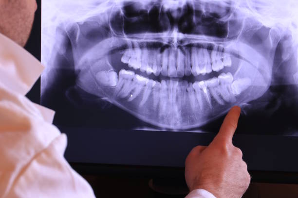 Emergency Dental Filling Replacement in IA